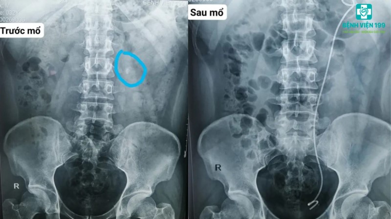 Nội soi ngược dòng tán sỏi tại Bệnh viện 199: Nhiều lợi ích bệnh nhân cần biết!